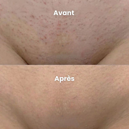 Rasoir Anti-Irritation Peaux Sensibles